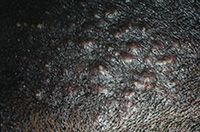 Tinea capitis (adult)